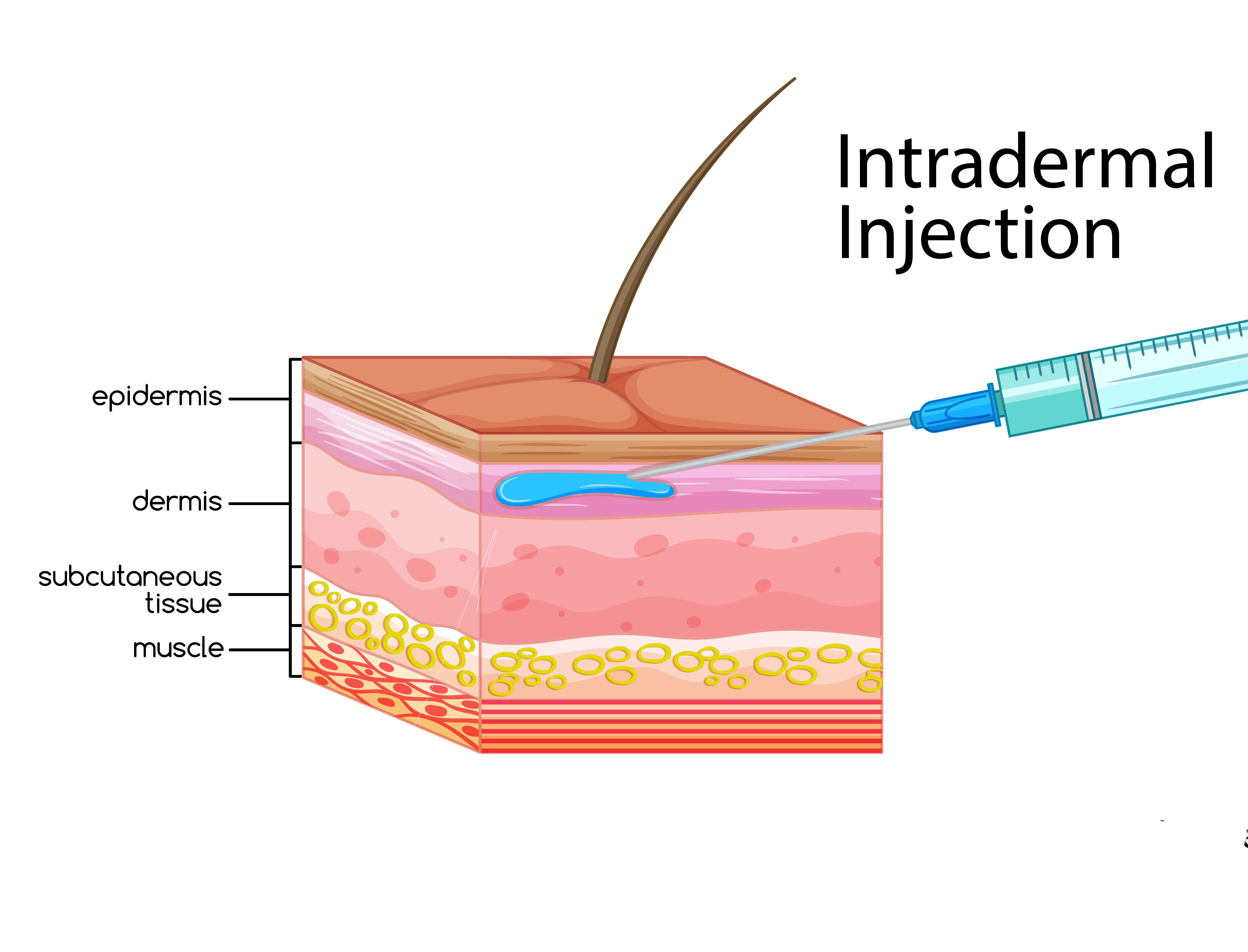 Intradermal Injection